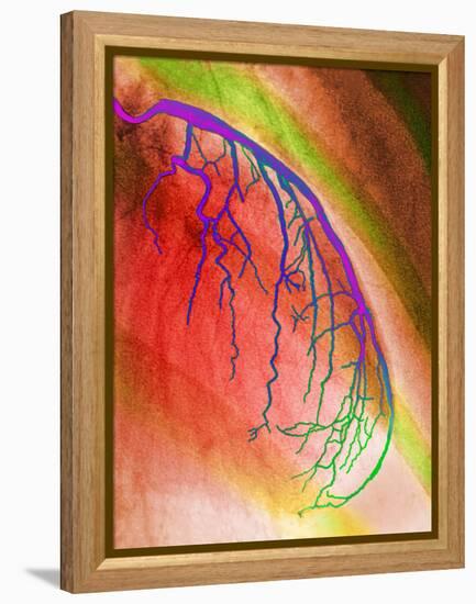 Coloured Angiogram of Coronary Artery of the Heart-Science Photo Library-Framed Premier Image Canvas