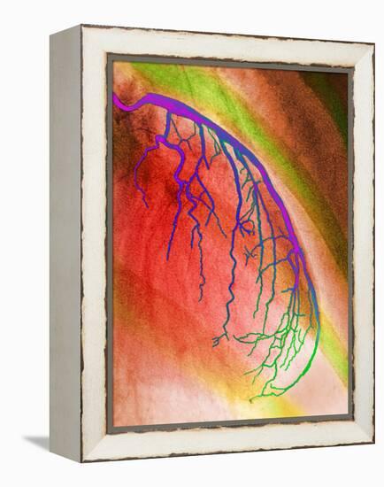 Coloured Angiogram of Coronary Artery of the Heart-Science Photo Library-Framed Premier Image Canvas