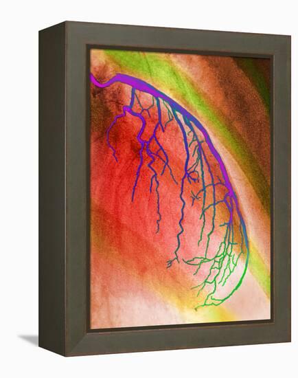 Coloured Angiogram of Coronary Artery of the Heart-Science Photo Library-Framed Premier Image Canvas