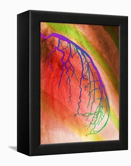 Coloured Angiogram of Coronary Artery of the Heart-Science Photo Library-Framed Premier Image Canvas