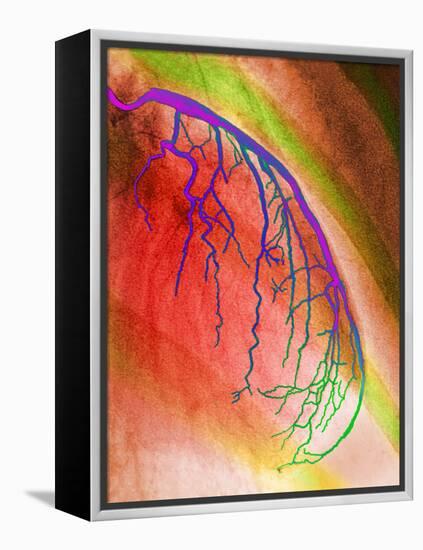 Coloured Angiogram of Coronary Artery of the Heart-Science Photo Library-Framed Premier Image Canvas