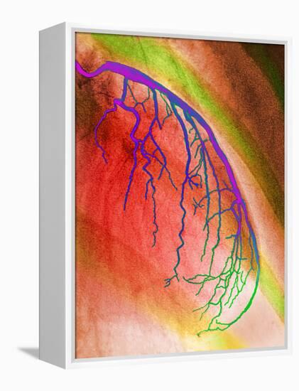 Coloured Angiogram of Coronary Artery of the Heart-Science Photo Library-Framed Premier Image Canvas