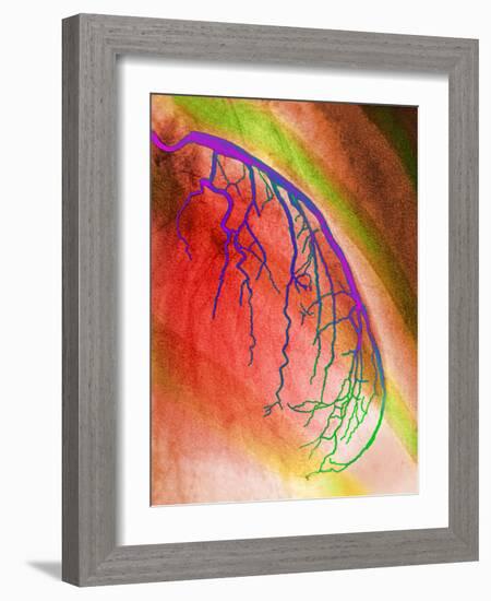 Coloured Angiogram of Coronary Artery of the Heart-Science Photo Library-Framed Photographic Print