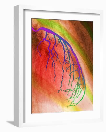 Coloured Angiogram of Coronary Artery of the Heart-Science Photo Library-Framed Photographic Print