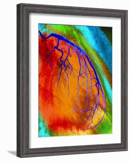 Coloured Angiogram of Coronary Artery of the Heart-Science Photo Library-Framed Photographic Print