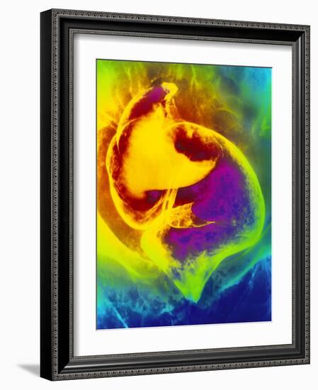 Coloured Barium X-ray Showing Cancer of the Colon-Mehau Kulyk-Framed Photographic Print