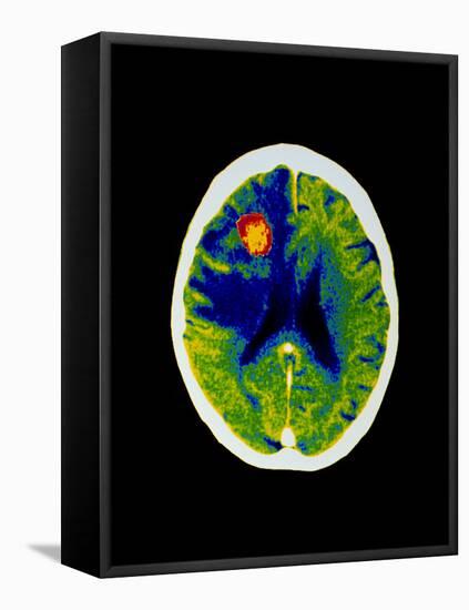 Coloured CT Scan of Brain Abscess In AIDS Patient-Science Photo Library-Framed Premier Image Canvas