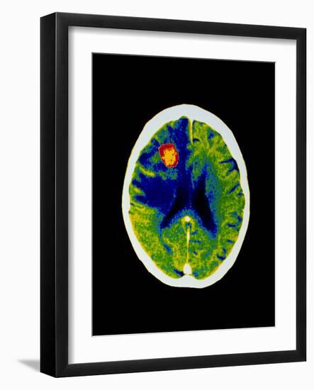 Coloured CT Scan of Brain Abscess In AIDS Patient-Science Photo Library-Framed Photographic Print