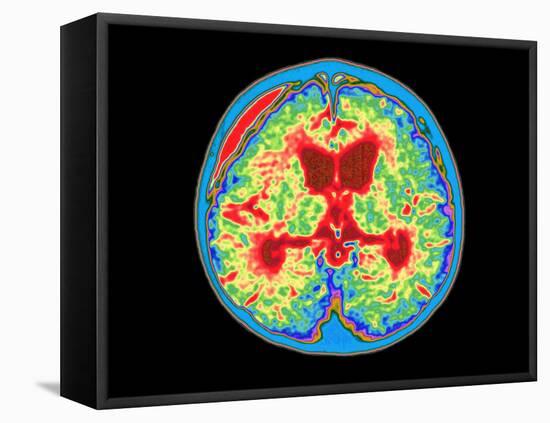 Coloured MRI Brain Scan of Abscess In Meningitis-Mehau Kulyk-Framed Premier Image Canvas