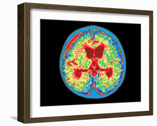 Coloured MRI Brain Scan of Abscess In Meningitis-Mehau Kulyk-Framed Photographic Print