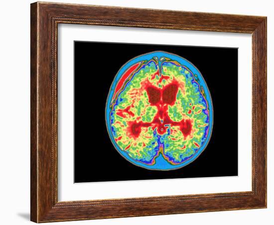 Coloured MRI Brain Scan of Abscess In Meningitis-Mehau Kulyk-Framed Photographic Print