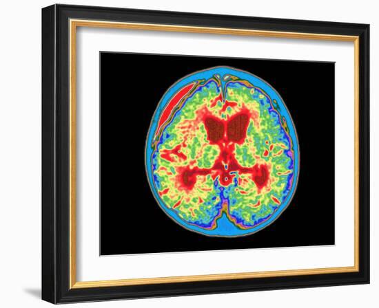 Coloured MRI Brain Scan of Abscess In Meningitis-Mehau Kulyk-Framed Photographic Print