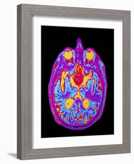 Coloured MRI Brain Scan: Pituitary Adenoma-Mehau Kulyk-Framed Photographic Print