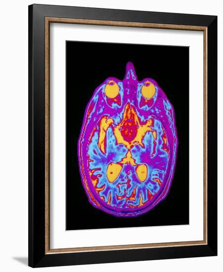 Coloured MRI Brain Scan: Pituitary Adenoma-Mehau Kulyk-Framed Photographic Print