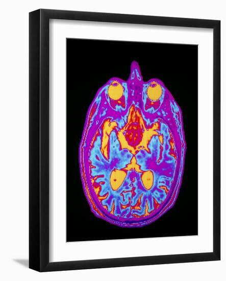 Coloured MRI Brain Scan: Pituitary Adenoma-Mehau Kulyk-Framed Photographic Print