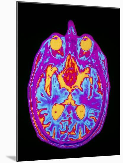 Coloured MRI Brain Scan: Pituitary Adenoma-Mehau Kulyk-Mounted Photographic Print