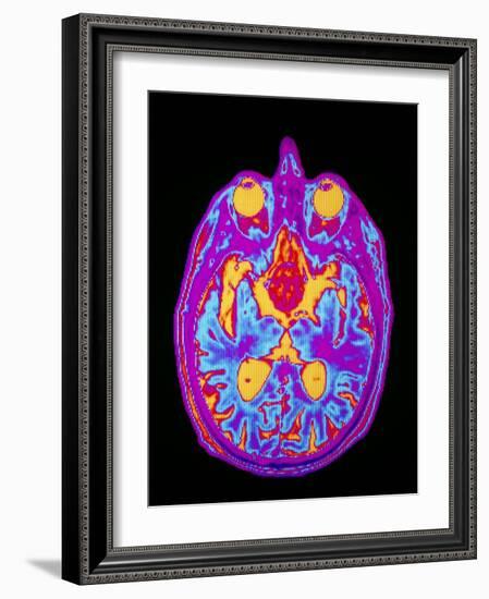 Coloured MRI Brain Scan: Pituitary Adenoma-Mehau Kulyk-Framed Photographic Print