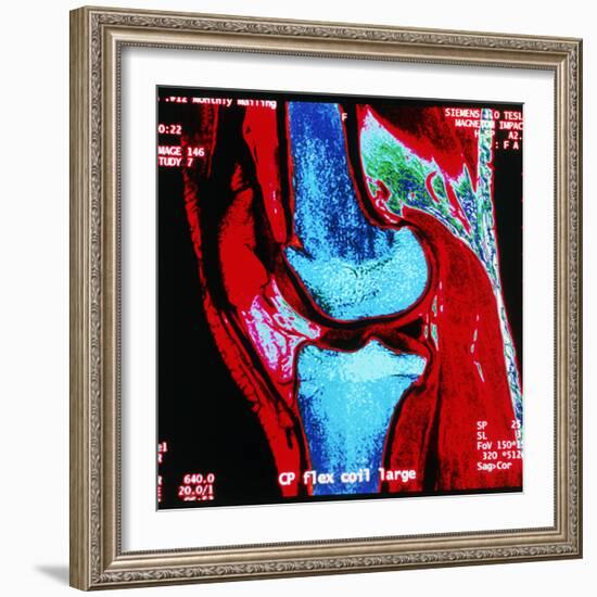 Coloured MRI Scan of Human Knee Joint, Side View-Geoff Tompkinson-Framed Premium Photographic Print