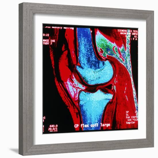 Coloured MRI Scan of Human Knee Joint, Side View-Geoff Tompkinson-Framed Premium Photographic Print