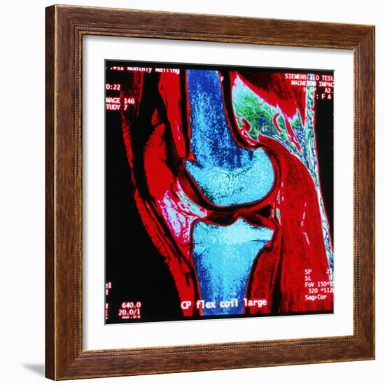 Coloured MRI Scan of Human Knee Joint, Side View-Geoff Tompkinson-Framed Premium Photographic Print