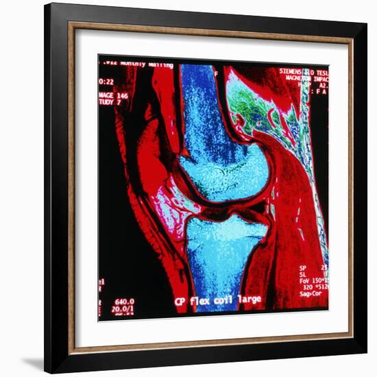 Coloured MRI Scan of Human Knee Joint, Side View-Geoff Tompkinson-Framed Premium Photographic Print