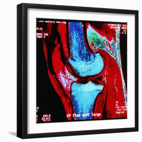 Coloured MRI Scan of Human Knee Joint, Side View-Geoff Tompkinson-Framed Premium Photographic Print