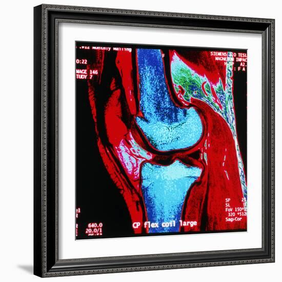 Coloured MRI Scan of Human Knee Joint, Side View-Geoff Tompkinson-Framed Premium Photographic Print