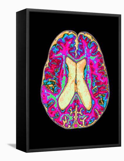 Coloured MRI Scan of Organophosphate Brain Damage-Mehau Kulyk-Framed Premier Image Canvas