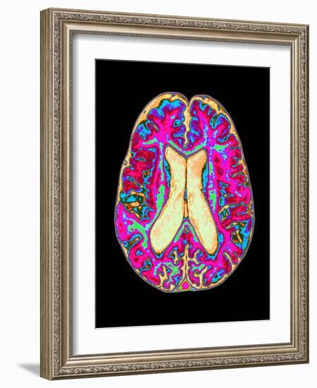 Coloured MRI Scan of Organophosphate Brain Damage-Mehau Kulyk-Framed Photographic Print