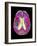 Coloured MRI Scan of Organophosphate Brain Damage-Mehau Kulyk-Framed Photographic Print