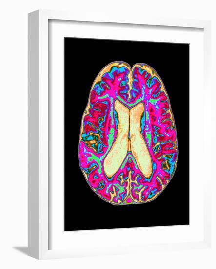 Coloured MRI Scan of Organophosphate Brain Damage-Mehau Kulyk-Framed Photographic Print