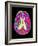 Coloured MRI Scan of Organophosphate Brain Damage-Mehau Kulyk-Framed Photographic Print