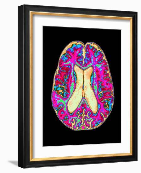 Coloured MRI Scan of Organophosphate Brain Damage-Mehau Kulyk-Framed Photographic Print