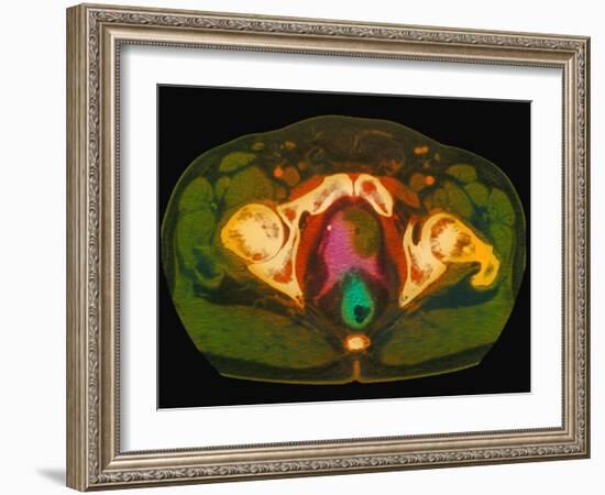 Coloured MRI Scan Showing Prostate Cancer-Science Photo Library-Framed Photographic Print