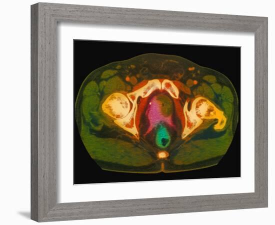 Coloured MRI Scan Showing Prostate Cancer-Science Photo Library-Framed Photographic Print