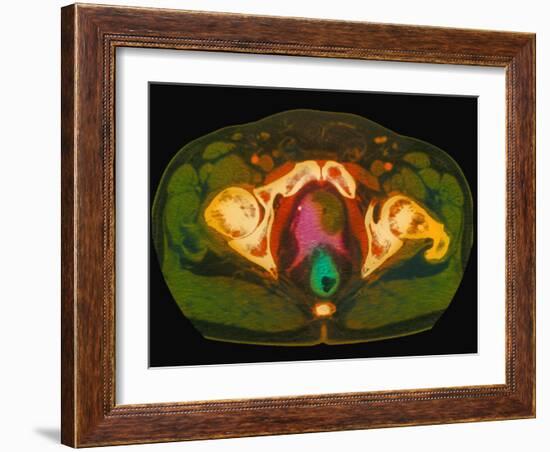 Coloured MRI Scan Showing Prostate Cancer-Science Photo Library-Framed Photographic Print