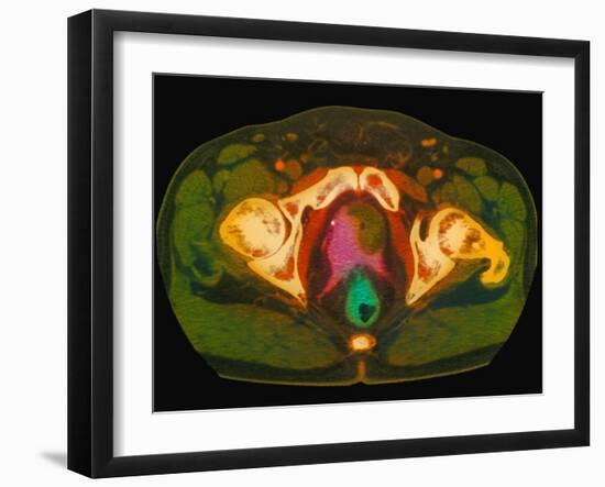 Coloured MRI Scan Showing Prostate Cancer-Science Photo Library-Framed Photographic Print