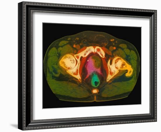 Coloured MRI Scan Showing Prostate Cancer-Science Photo Library-Framed Photographic Print