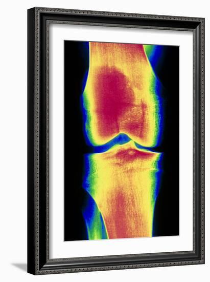 Coloured X-ray Image of a Normal Knee-joint-PASIEKA-Framed Photographic Print