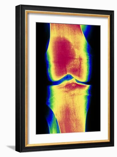 Coloured X-ray Image of a Normal Knee-joint-PASIEKA-Framed Photographic Print