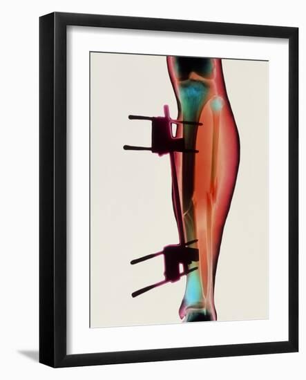 Coloured X-ray of a Fractured Tibia & Fibula-Science Photo Library-Framed Photographic Print