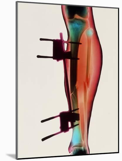 Coloured X-ray of a Fractured Tibia & Fibula-Science Photo Library-Mounted Photographic Print