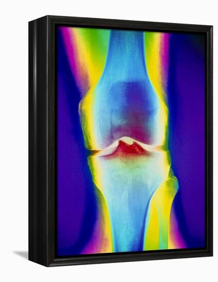 Coloured X-ray of a Human Knee Joint-Mehau Kulyk-Framed Premier Image Canvas