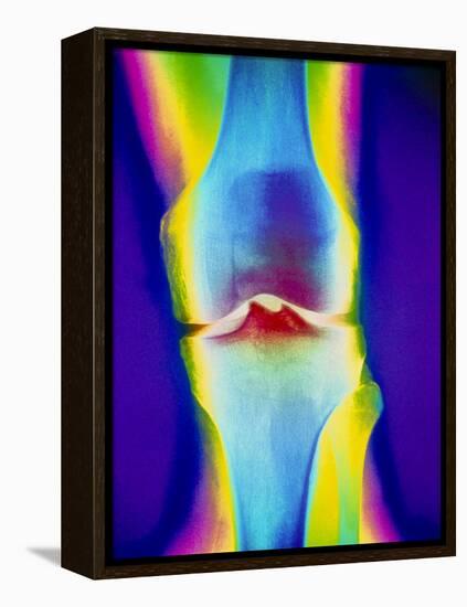 Coloured X-ray of a Human Knee Joint-Mehau Kulyk-Framed Premier Image Canvas