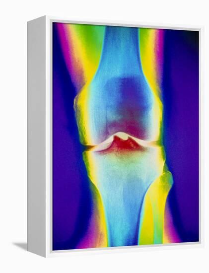 Coloured X-ray of a Human Knee Joint-Mehau Kulyk-Framed Premier Image Canvas