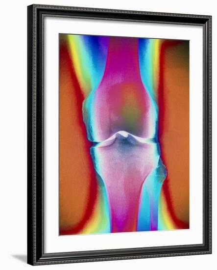 Coloured X-ray of a Human Knee Joint-Mehau Kulyk-Framed Photographic Print