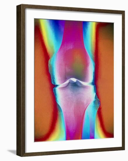Coloured X-ray of a Human Knee Joint-Mehau Kulyk-Framed Photographic Print