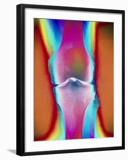 Coloured X-ray of a Human Knee Joint-Mehau Kulyk-Framed Photographic Print