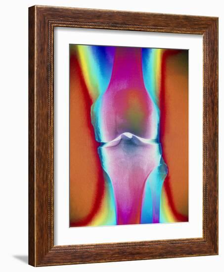 Coloured X-ray of a Human Knee Joint-Mehau Kulyk-Framed Photographic Print