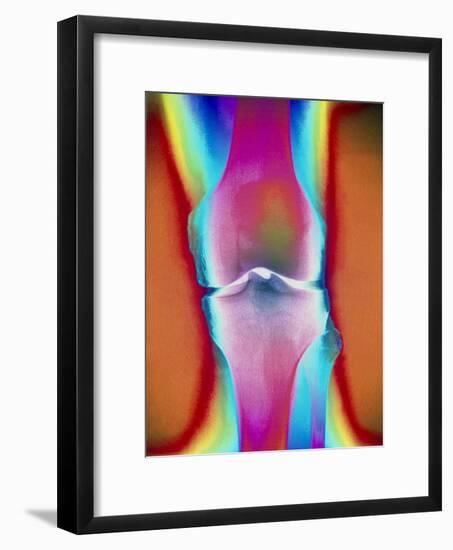 Coloured X-ray of a Human Knee Joint-Mehau Kulyk-Framed Photographic Print